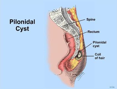 Pilonidal Sinus Recurrence